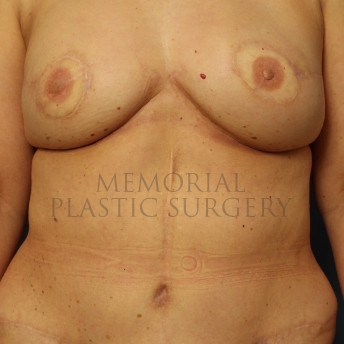 A front view after photo of patient 315 that underwent DIEP Flap Surgery procedures at Memorial Plastic Surgery