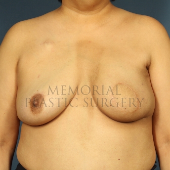 A front view after photo of patient 278 that underwent DIEP Flap Surgery procedures at Memorial Plastic Surgery
