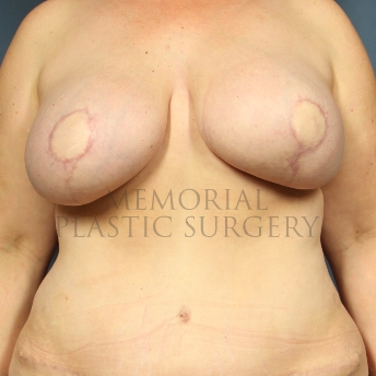 A front view after photo of patient 324 that underwent DIEP Flap Surgery procedures at Memorial Plastic Surgery