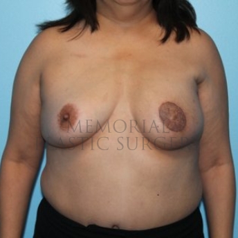 A front view after photo of patient 191 that underwent DIEP Flap Surgery procedures at Memorial Plastic Surgery