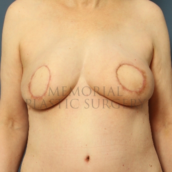 A front view after photo of patient 335 that underwent DIEP Flap Surgery procedures at Memorial Plastic Surgery