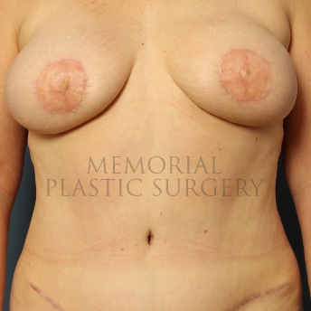 A front view after photo of patient 349 that underwent DIEP Flap Surgery procedures at Memorial Plastic Surgery