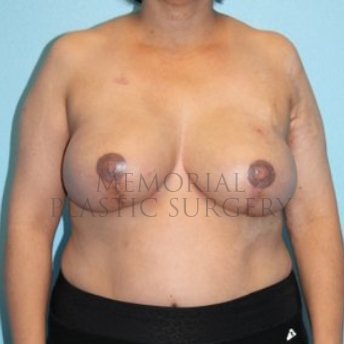 A front view after photo of patient 291 that underwent DIEP Flap Surgery procedures at Memorial Plastic Surgery