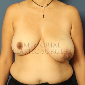 A front view before photo of patient 358 that underwent DIEP Flap Surgery procedures at Memorial Plastic Surgery