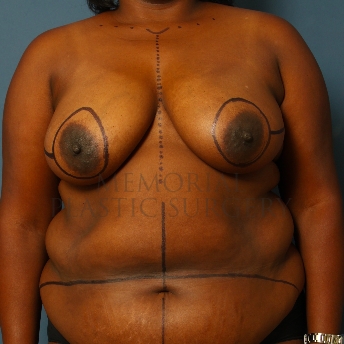 A front view before photo of patient 320 that underwent DIEP Flap Surgery procedures at Memorial Plastic Surgery