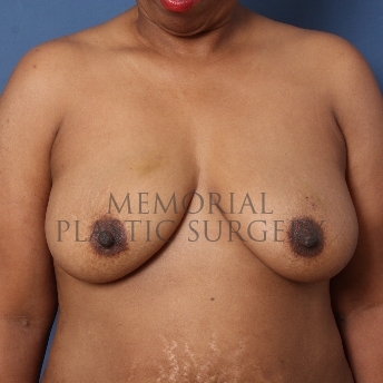 A front view before photo of patient 271 that underwent DIEP Flap Surgery procedures at Memorial Plastic Surgery