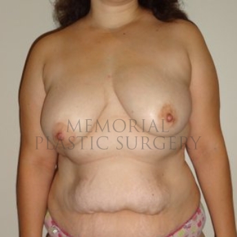 A front view before photo of patient 293 that underwent DIEP Flap Surgery procedures at Memorial Plastic Surgery