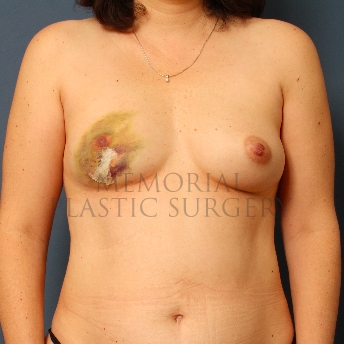 A front view before photo of patient 314 that underwent DIEP Flap Surgery procedures at Memorial Plastic Surgery