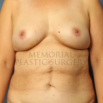 A front view before photo of patient 315 that underwent DIEP Flap Surgery procedures at Memorial Plastic Surgery