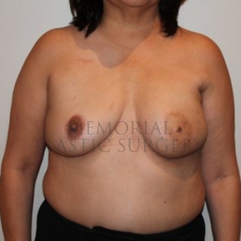 A front view before photo of patient 191 that underwent DIEP Flap Surgery procedures at Memorial Plastic Surgery
