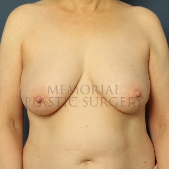 A front view before photo of patient 335 that underwent DIEP Flap Surgery procedures at Memorial Plastic Surgery