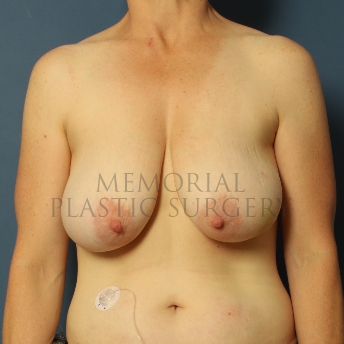 A front view before photo of patient 285 that underwent DIEP Flap Surgery procedures at Memorial Plastic Surgery
