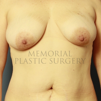 A front view before photo of patient 349 that underwent DIEP Flap Surgery procedures at Memorial Plastic Surgery