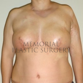 A front view before photo of patient 291 that underwent DIEP Flap Surgery procedures at Memorial Plastic Surgery