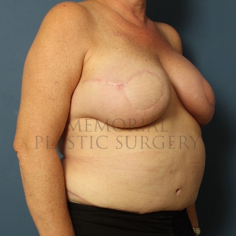 A oblique view after photo of patient 322 that underwent DIEP Flap Surgery procedures at Memorial Plastic Surgery