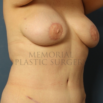 A oblique view after photo of patient 349 that underwent DIEP Flap Surgery procedures at Memorial Plastic Surgery