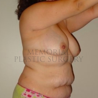 A oblique view before photo of patient 293 that underwent DIEP Flap Surgery procedures at Memorial Plastic Surgery