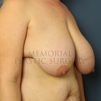 A oblique view before photo of patient 324 that underwent DIEP Flap Surgery procedures at Memorial Plastic Surgery