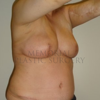 A oblique view before photo of patient 291 that underwent DIEP Flap Surgery procedures at Memorial Plastic Surgery