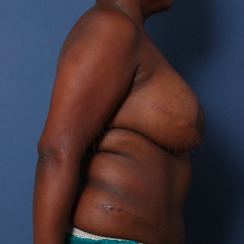 A side view after photo of patient 320 that underwent DIEP Flap Surgery procedures at Memorial Plastic Surgery