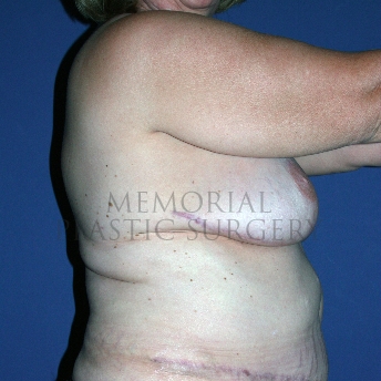 A side view after photo of patient 354 that underwent DIEP Flap Surgery procedures at Memorial Plastic Surgery