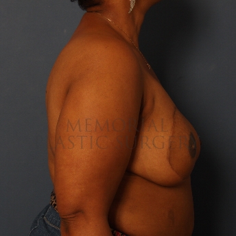 A side view after photo of patient 271 that underwent DIEP Flap Surgery procedures at Memorial Plastic Surgery