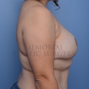 A side view after photo of patient 293 that underwent DIEP Flap Surgery procedures at Memorial Plastic Surgery