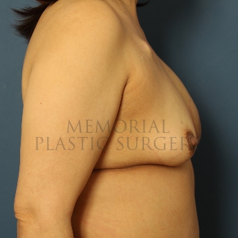 A side view after photo of patient 278 that underwent DIEP Flap Surgery procedures at Memorial Plastic Surgery