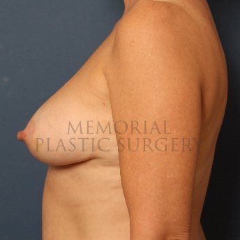 A side view after photo of patient 370 that underwent DIEP Flap Surgery procedures at Memorial Plastic Surgery
