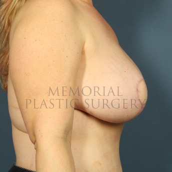 A side view after photo of patient 324 that underwent DIEP Flap Surgery procedures at Memorial Plastic Surgery