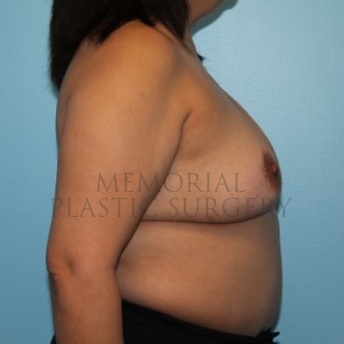 A side view after photo of patient 191 that underwent DIEP Flap Surgery procedures at Memorial Plastic Surgery