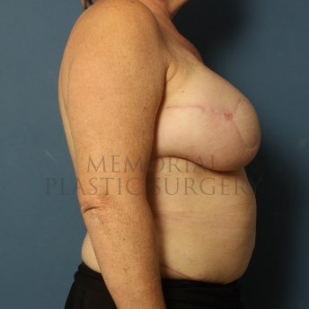 A side view after photo of patient 322 that underwent DIEP Flap Surgery procedures at Memorial Plastic Surgery