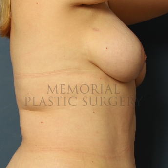A side view after photo of patient 349 that underwent DIEP Flap Surgery procedures at Memorial Plastic Surgery