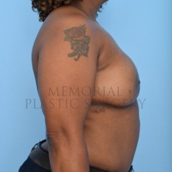 A side view after photo of patient 292 that underwent DIEP Flap Surgery procedures at Memorial Plastic Surgery