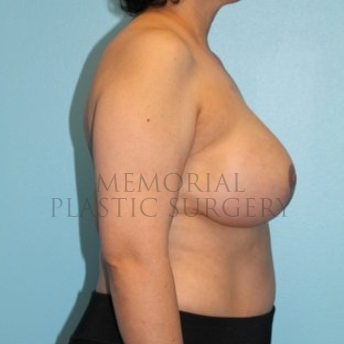 A side view after photo of patient 291 that underwent DIEP Flap Surgery procedures at Memorial Plastic Surgery