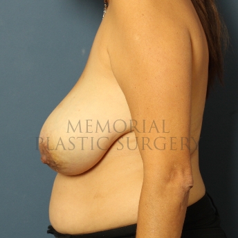A side view before photo of patient 358 that underwent DIEP Flap Surgery procedures at Memorial Plastic Surgery