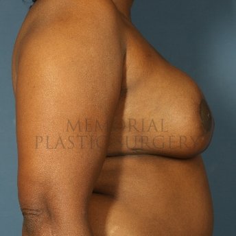 A side view before photo of patient 317 that underwent DIEP Flap Surgery procedures at Memorial Plastic Surgery