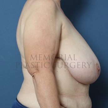 A side view before photo of patient 354 that underwent DIEP Flap Surgery procedures at Memorial Plastic Surgery