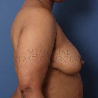 A side view before photo of patient 271 that underwent DIEP Flap Surgery procedures at Memorial Plastic Surgery