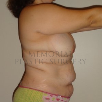 A side view before photo of patient 293 that underwent DIEP Flap Surgery procedures at Memorial Plastic Surgery
