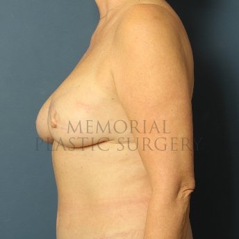A side view before photo of patient 370 that underwent DIEP Flap Surgery procedures at Memorial Plastic Surgery