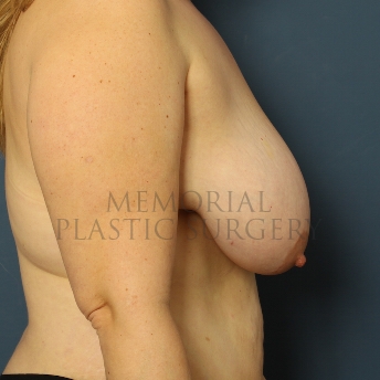 A side view before photo of patient 324 that underwent DIEP Flap Surgery procedures at Memorial Plastic Surgery