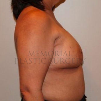 A side view before photo of patient 191 that underwent DIEP Flap Surgery procedures at Memorial Plastic Surgery