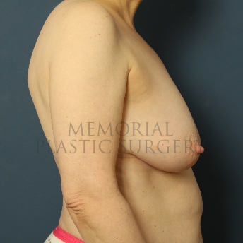 A side view before photo of patient 335 that underwent DIEP Flap Surgery procedures at Memorial Plastic Surgery