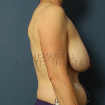 A side view before photo of patient 285 that underwent DIEP Flap Surgery procedures at Memorial Plastic Surgery