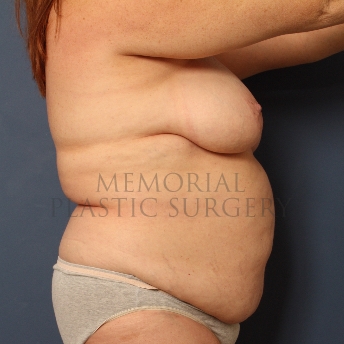 A side view before photo of patient 322 that underwent DIEP Flap Surgery procedures at Memorial Plastic Surgery