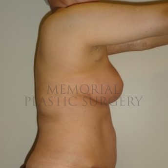 A side view before photo of patient 291 that underwent DIEP Flap Surgery procedures at Memorial Plastic Surgery