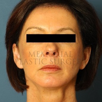 A front view after photo of patient 236 that underwent Face Lift procedures at Memorial Plastic Surgery