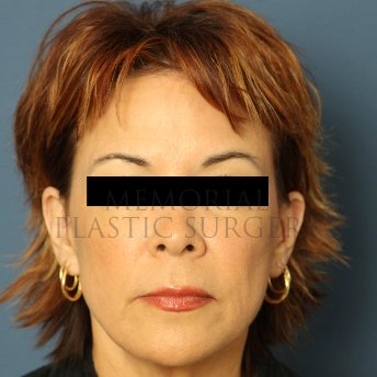 A front view after photo of patient 234 that underwent Face Lift procedures at Memorial Plastic Surgery