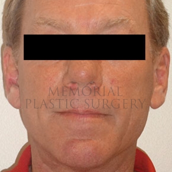 A front view after photo of patient 180 that underwent Face Lift procedures at Memorial Plastic Surgery